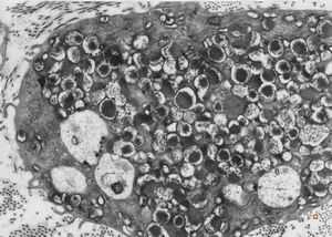 M,40y. | granular cell tumor